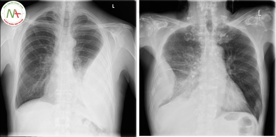 Hình ảnh X-quang ngực 