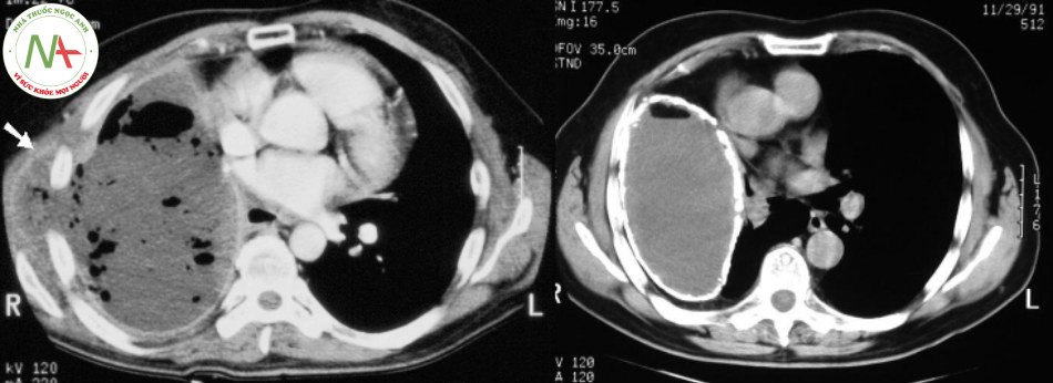 Hình ảnh chụp cắt lớp vi tính phổi