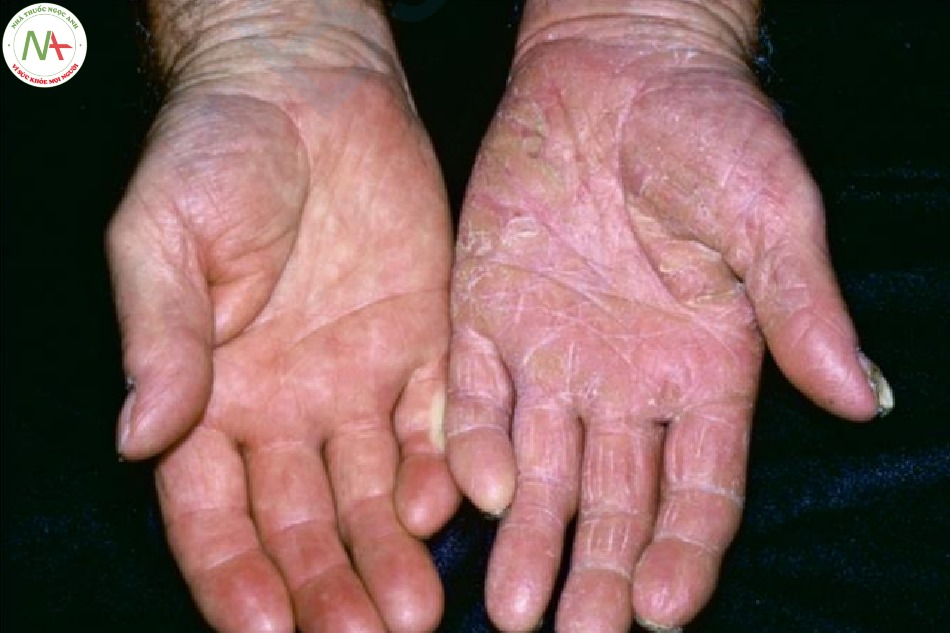 Nấm bàn tay – dát có vảy lan tỏa ở chỉ một tay trên bệnh nhân có nấm bàn chân – hội chứng “một tay, hai chân”