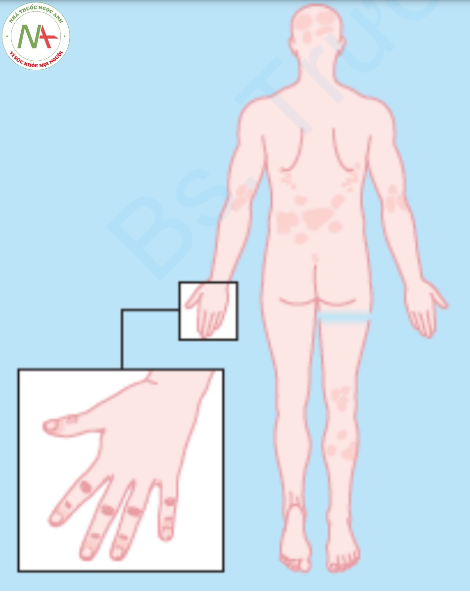 Phân bố điển hình của vảy nến – khuỷu tay, đầu gối, da đầu, vùng kẽ và móng