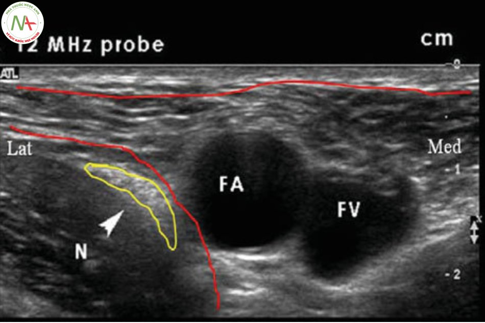 Trên hình ảnh siêu âm, động mạch đùi (FA), tĩnh mạch đùi (FV), thần kinh đùi (N)
