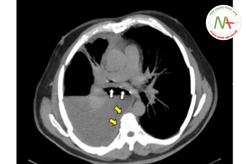 Hình 2. CT ngực không cản quang cho thấy khoang màng phổi bị chia tách thành các xoang. Xoang lớn có chứa dịch dạng mủ với phản ứng dày của lá thành (mũi tên vàng) và lá tạng (mũi tên trắng).