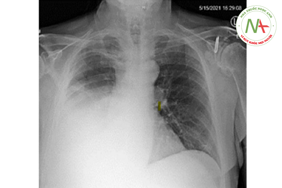 Hình 1. X-quang ngực khi vào, mờ 1/2 dưới phổi phải.