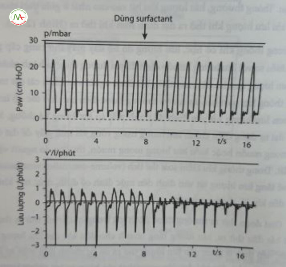 Hình 12,10 Áp lực đường thở (P.) (hình trên) và lưu lượng khí (hình dưới) trong một bản ghi nén (16 giây) suốt quá trình tác nghẽn một phần đường thở đột ngột do sử dụng surfactant trong khí quản. Lưu ý. Mặc dù PIP không thay đổi, song lưu lượng đình trong thì hít vào và thở ra đột ngột giảm sau khi dùng surfactant. (Được sự cho phép của Tiến sĩ Andreas Schulze, Munich, Đức),