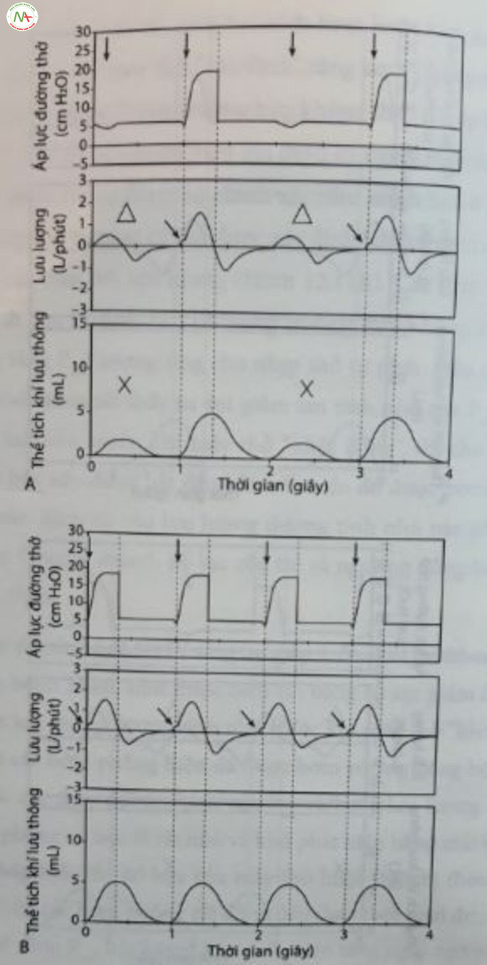 Hình 12.12 Kiểm tra đồng bộ hóa. Thông khí bắt buộc ngất quang đồng bộ (SIMV) so với trợ giúp-kiểm soát (AC). (A) SIMV (tần số: 30 lần/phút; thời gian hít vào [T]: 0,3 giây). Lưu ý. Sự hiện diện của nhịp thở tự phát (60 lần/phút) được biểu thị bằng sự giảm nhẹ áp lực đường thở (P..) (+) cũng như lưu lượng hít vào và thở ra nhỏ (A), dẫn đến thể tích khí lưu thông nhỏ aw (X) giữa các bơm phòng cơ học. Lưu lượng hít vào tăng nhẹ trước khi các bơm phồng cổ học đẩy vào” và tăng lưu lượng thêm nữa (mũi tên ở hàng thứ hai). (B) A/C (T: 0,3 giay). Lưu Ý Nhịp thở tự phát được biểu thị bằng sự giảm nhẹ Phu (l) và sự gia tăng nhẹ lưu lượng hít insp vào trước khi bơm phòng cơ học “đẩy vào” và tăng lưu lượng thêm nữa (mũi tên ở hàng thứ hai). Mỗi nỗ lực kích hoạt một bơm phòng cơ học đều dẫn đến tàn số 60 làn/phút.