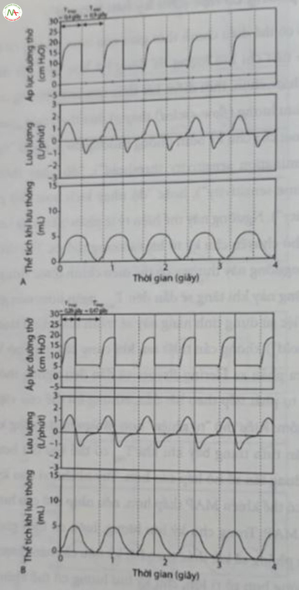 Hình 12.13 Chu kỳ bơm phồng cơ học (chu kỳ lưu lượng, “kích hoạt thở ra”). (A) Thông khí giới hạn áp lực đồng bộ, chế độ trợ giúp/kiểm soát: Áp lực hít vào đỉnh (PIP)/áp lực dưỡng cuối thì thở ra (PEEP) 18/6 cm H,O, thời gian hút vào (T) là 0,4 giây, tần số họ hấp tự phát 75 nhịp thở/phút dẫn đến thời gian thở ra (T...) là 0,4 giây, TinspiTe exp Lưu ý: Thở ra hoàn toàn bị ngăn cản bởi thời gian bơm phồng cơ học. (B) Thông khí giới hạn áp lực đồng bộ; chế độ trợ giúp/kiểm soát với chu kỳ lưu lượng (được gọi là thông khí hỗ trợ áp lực trong một số thiết bị), độ nhạy kết thúc 40% của lưu lượng đỉnh: PIP/ exp PEEP 18/6 cm H,O, Tin. 0,4 giây, chấm dứt ở 0,28 giây (các đường nét liền thẳng đứng), hô hấp tự phát tần số 80 nhịp thờ/phút dẫn đến T., là 0,47 giây, Tin Te exp Không còn “giữ hít vào” nữa và thể tích khí lưu thông không thay đổi. inspexp = 1:1,7. Luu y = 1:1.