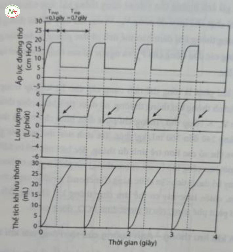 Hình 12.14 Rò rỉ ống nội khí quản lớn khiến lưu lượng khí dương trong thì hít vào và thở ra. Cài đặt: Thời gian hít vào là 0,3 giây; thời gian thở ra là 0,7 giây; rò rỉ (100%). Lưu lượng khí hít vào là quá mức và vẫn dương trong giai đoạn thở ra (mũi tên), dẫn đến “hiện tượng chạy trốn” của biểu đồ sóng thể tích khí lưu thông (V,). V, thở ra chỉ đi vào lỗ ro. Không thể theo dõi V, trong tình trạng này. Cần lưu ý xem xét sự di lệch của ông nội khí quản. Nó được làm zero điện tử trước điểm bơm phòng tiếp theo.