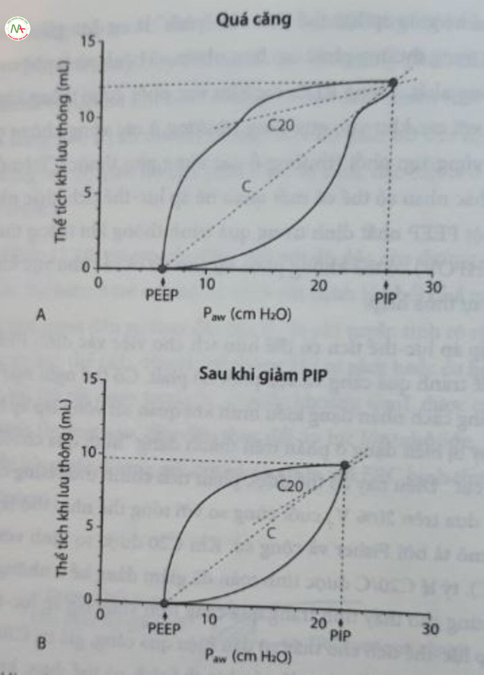 Hình 12,21 Vòng lặp áp lực-thể tích với bằng chứng về quá căng. Vòng lặp A cho thấy bằng chứng về tình trạng quá căng với phần cuối cùng của vòng lặp phẳng dẹt. Sau khi giảm phân dẹt của PIP, vòng lặp áp lực thể tích đã (gần như) biến mất. (A) Quá căng. (B) Sau khi giảm PIP. P... áp lực đường thở; PEEP, áp lực dương cuối thì thở ra; PIP, áp lực bơm phòng định
