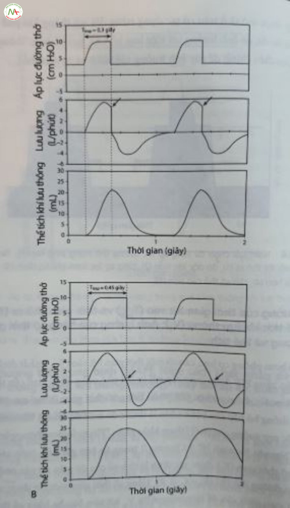 Hình 12.7 Ảnh hưởng của thời gian hít vào lên thể tích khí lưu thông được cung cấp trong bơm phòng cơ học giới hạn áp lực. Trẻ sơ sinh đủ tháng với cơ học phổi bình thường. (A) Thời gian hít vào (T...) là 0,3 giây. Lưu lượng hít vào đột ngột trở về 0 (mũi tên) mà không cho phép bơm phòng hoàn thành (thể tích khí lưu thông [V,) - 21 mL). (B) T insp = 0,45 giây. Lưu lượng hít vào được phép giảm đến 0 (mũi tên), dân đến V, lớn = hơn khi sử dụng cùng một áp lực bơm phồng đình (V, ~ 24 ml).