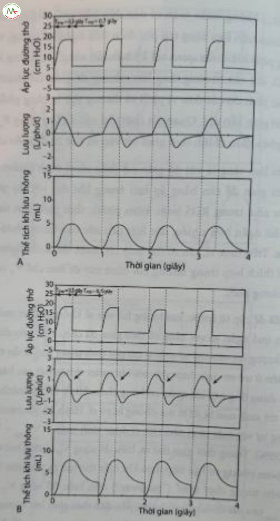 Hình 12.9 . Ảnh hưởng của rò rỉ ống nội khí quản lên biểu đồ sóng lưu lượng và thể tích khí lưu thông (V,) trong bơm phòng cơ học giới hạn áp lực. Trẻ sinh non với hội chứng suy hô hấp (RDS). (A) Thời gian hít vào (Tmp) là 0,3 giây; thời gian thở ra (7) là 0,7 giây, không rò rỉ. Lưu lượng hít vào trở về mức 0 trước khi kết thúc bơm phòng cơ học. Lưu ý. : 0,3 giây; T. = insp Biểu đồ sóng V, trở về mức 0 mL trước lần bơm phồng tiếp theo. (B) T insp = 0,7 giây; có rò rỉ (35%). Lưu lượng hít vào không đạt đến 0 trước bơm phòng cơ học tiếp theo (mũi tên). Lưu ý: Biểu đồ sóng V, không trở lại mức 0 mL trong thì thở ra. Nó được làm zero điện tử trước điểm bơm phòng tiếp theo.