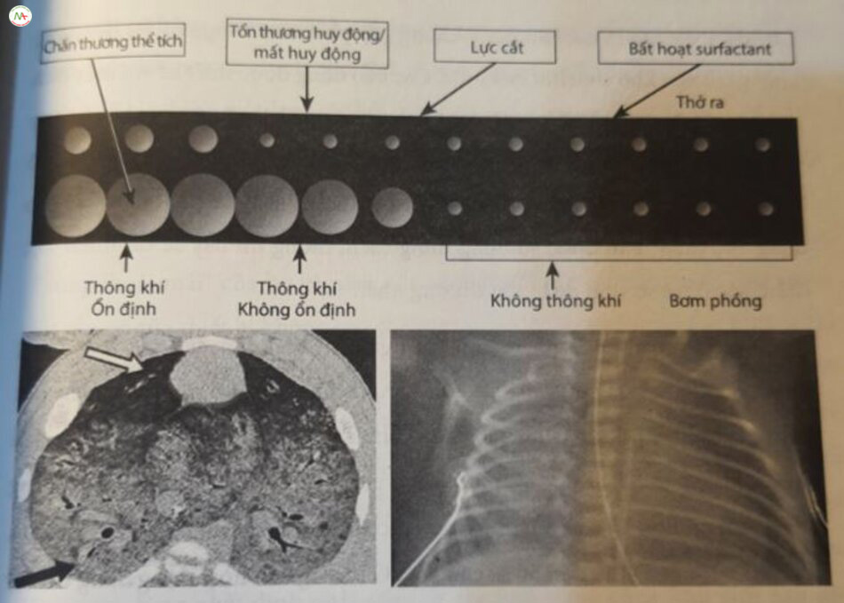 Hình 22.10 Tam quan trọng của khái niệm phối mà. Mặc dù chụp X-quang phổitrước sau làm cho phối của trẻ sơ sinh bị hỏi chung suy hô hấp có vẻ động nhất (phía dưới bên phải), đây là một hình ảnh nhiều của một hình ảnh hai chiều về cấu trúc ba chiêu. Xẹp phối có phân bỏ phụ thuộc vào trọng lực như được minh họa trên chế độ chụp cắt lớp vi tính ở phía dưới bên trái. Tình huống này được biểu diễn sơ đồ ở phía trên, Thông khi phối với sự hiện diện của xẹp phổi rộng dân đến chân thường xếp phối Gatelectrauma). Surfactant bất hoạt ở phần phối xẹp, lúc cát ở ranh giới giữa phối được sục khí và không được sục khí, trong đó tổn thương từ sự xếp và mà phê nang lập đi lập lại không ổn định đều góp phần vào tổn thương phối. Có lẽ quan trọng nhất, khi mở rộng một phân phối xếp sẽ ưu tiên đi vào phần đã được sục khi của phổi (mũi tên màu tráng ở hình phía dưới bên trái), đòi hỏi áp lực ít hơn so với áp lực mà tại hạn của vùng phối xếp, được biểu thị bởi mũi tên màu đen ở hình phía dưới bên trai (định luật LaPlace xem Chương 2). Do đó, ngay cả một thể tích khi lưu thông sinh lý bình thường, khi xâm nhập vào phần nhỏ của phế nang mà chắc chân sẽ dẫn đến tình trạng căng quá mức và chân thương thể tích (volutrauma).