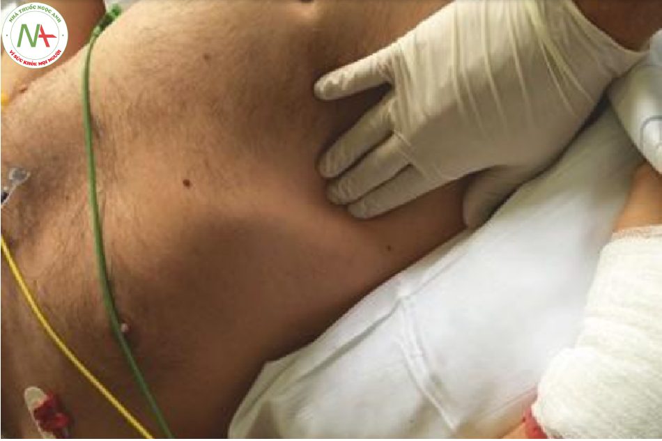 Hình 10 Sờ nắn bụng để phát hiện hoặc loại trừ xem bệnh nhân có đang “chiến đấu” với máy thở trong khi thở máy được kiểm soát hay không