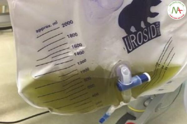 Hình 10.5 Nước tiểu màu xanh lục nhạt ở một bệnh nhân dùng thuốc nhuộm xanh methylen