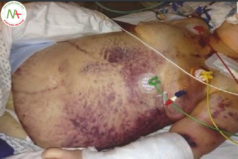 Hình 12.10 Purpura Fulminans - ban xuất huyết bùng phát (chảy máu da rộng) ở một bệnh nhân bị nhiễm trùng với DIC giai đoạn giảm đông nghiêm trọng
