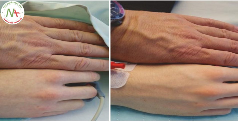 Hình 13 Kiểm tra hồi sức sự đổ đầy tĩnh mạch ngoại biên. Người thăm khám dùng bàn tay làm tham chiếu trên cả hai tay để đánh giá tình trạng thể tích của bệnh nhân