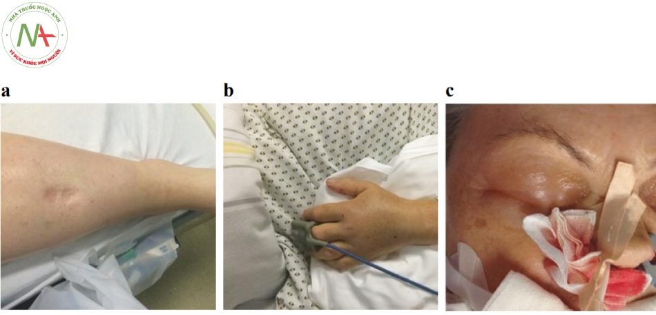 Hình 15 Các giai đoạn khác nhau của phù nề liên quan đến rò rỉ mao mạch: (a) phù trước xương chày, (b) phù tay và cuối cùng (c) phù mặt