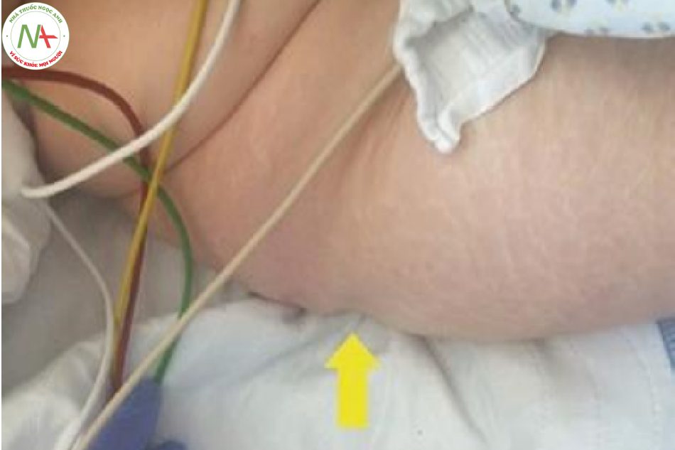 Hình 16 Mức độ phù lõm (mũi tên màu vàng) tối đa ở bệnh nhân bị bệnh nghiêm trọng mãn tính xảy ra quanh mông, sườn và đùi