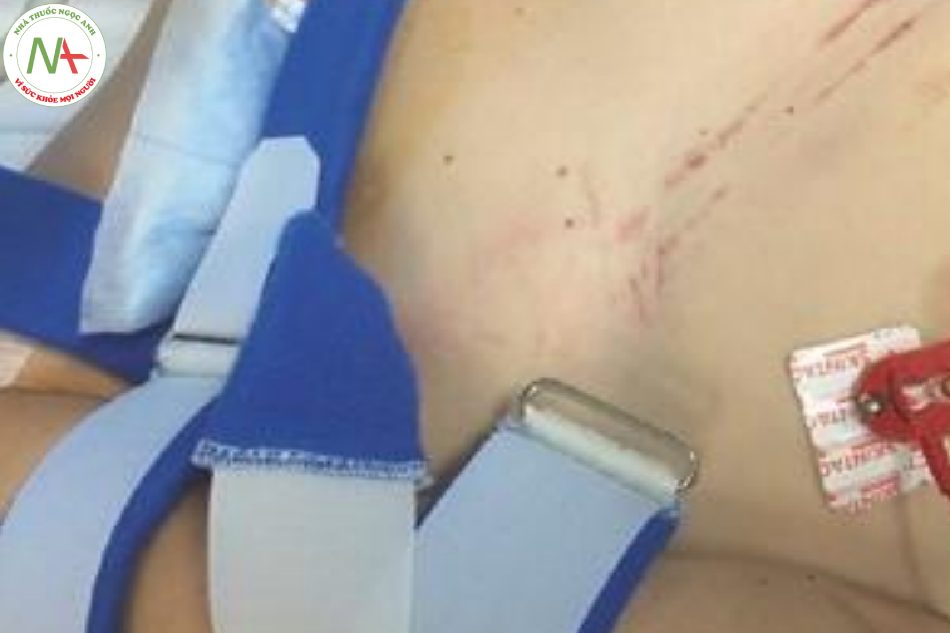 Hình 16.5 “Dấu hiệu thắt dây an toàn” ở một bệnh nhân bị chấn thương ngực