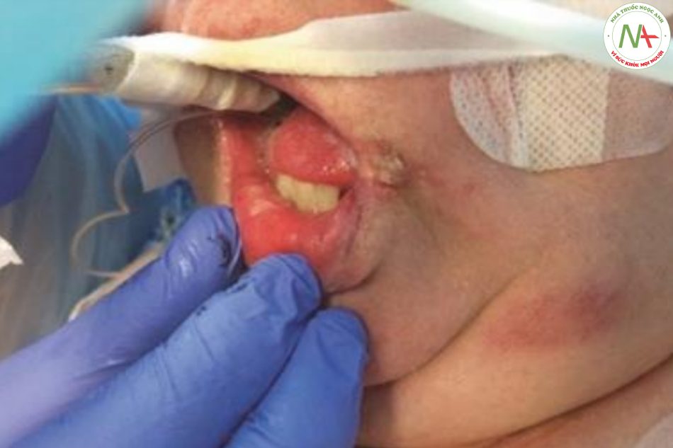 Hình 17.4 Nhiễm herpes miệng (tái hoạt) ở một bệnh nhân đang hồi phục sau viêm phổi do phế cầu khuẩn