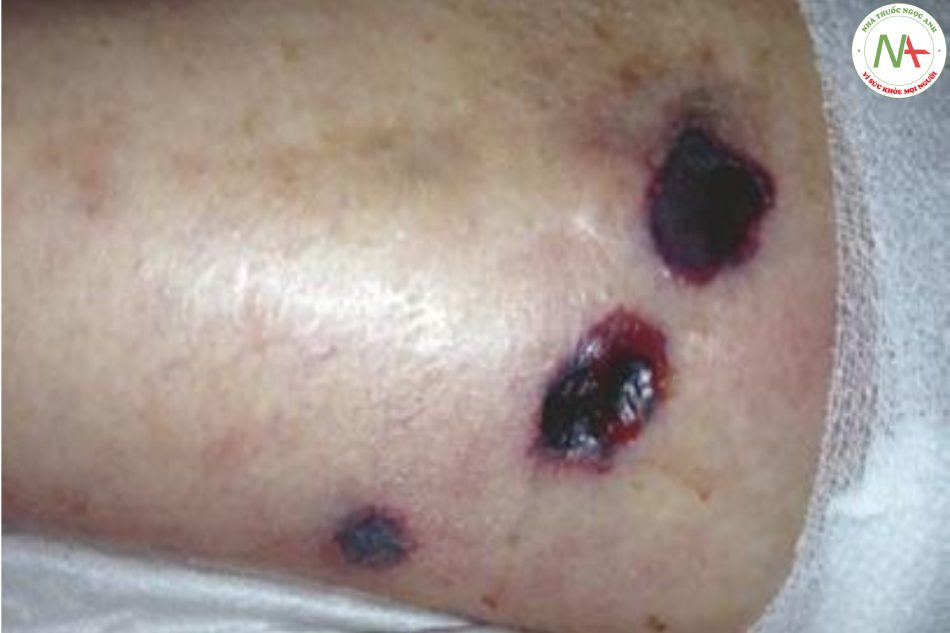 Hình 17.5 Ban đỏ hoại thư - một tổn thương da thường liên quan đến nhiễm Pseudomonas aeruginosa