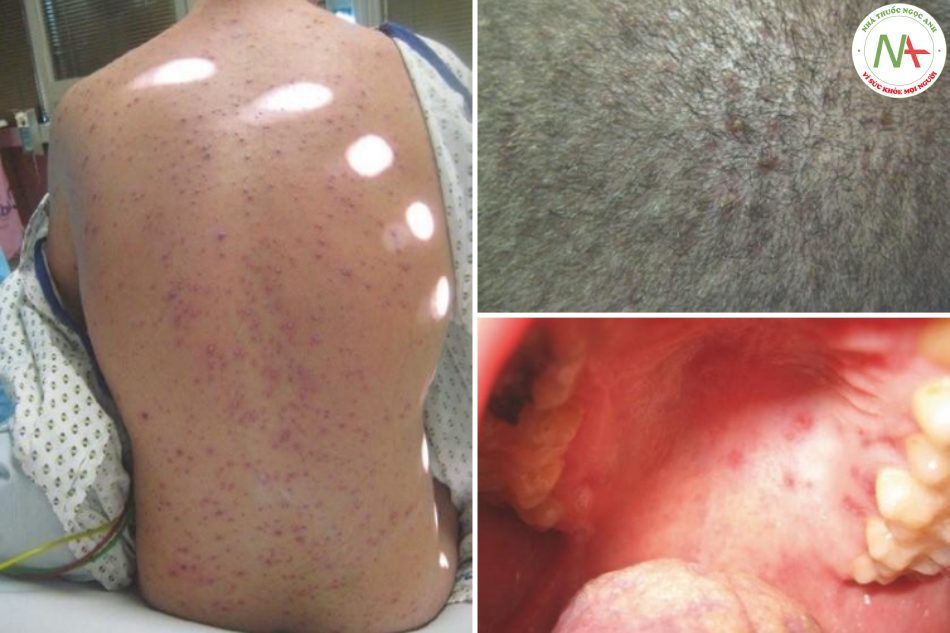 Hình 17.9 Những thay đổi đặc trưng của da (a), da đầu (b) và niêm mạc miệng (c) ở bệnh nhân trưởng thành bị nhiễm Varicella zoster