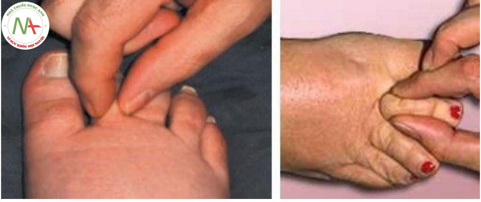 Hình 18c. Test Stemmer dương tính: không véo được lớp da trên ngón chân lên