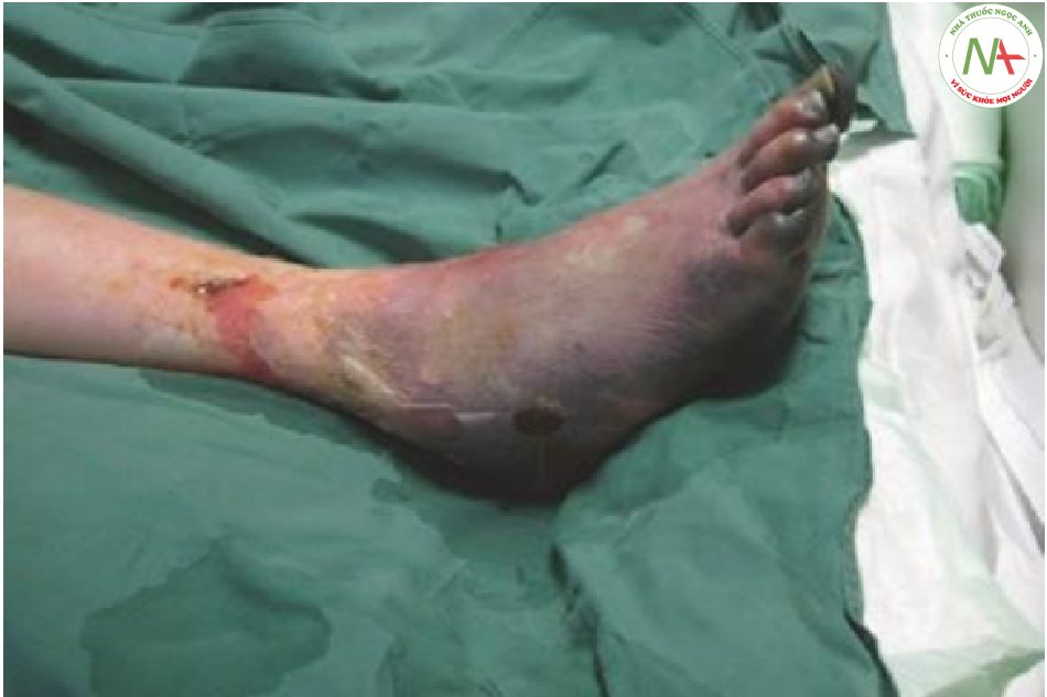 Hình 21.16 Bỏng do băng giá độ ba của bàn chân phải. Lưu ý các vết phồng rộp máu ở mặt bên của bàn chân và sự đổi màu đặc trưng màu xanh xám của da