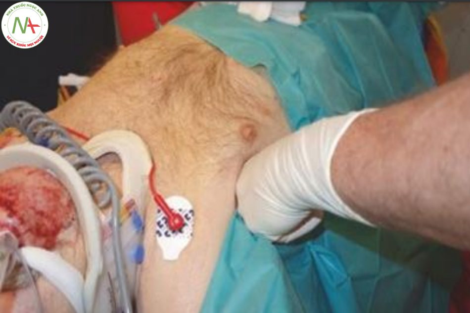 Hình 25 Sờ nắn phổi ở bệnh nhân bị chấn thương ngực nghiêm trọng trong phẫu thuật ngực và đặt ống dẫn lưu ngực