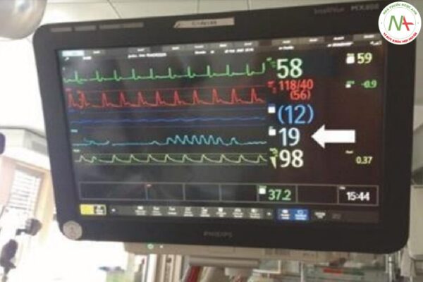 Hình 7.11 Tìm kiểu thở trên màn hình của một bệnh nhân mắc bệnh não chuyển hóa và thở Cheyne-Stokes