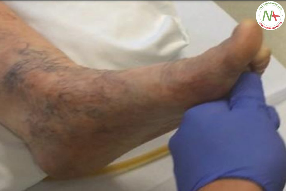 Hình 7.12 Phản ứng duỗi cơ gan bàn chân hoặc dấu hiệu Babinski bên trái (“ngón chân cái hếch lên”) ở một bệnh nhân bị đột quỵ bên phải