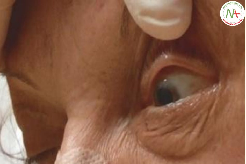 Hình 7.21 Mở mắt thụ động có thể cho thấy tình trạng giật mí mắt theo nhịp điệu tinh vi ở bệnh nhân động kinh không co giật