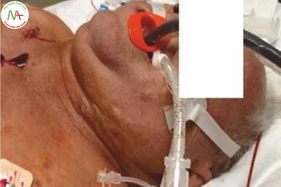 Hình 8 Đặc điểm lâm sàng của một bệnh nhân bị shock tắc nghẽn do chèn ép màng ngoài tim