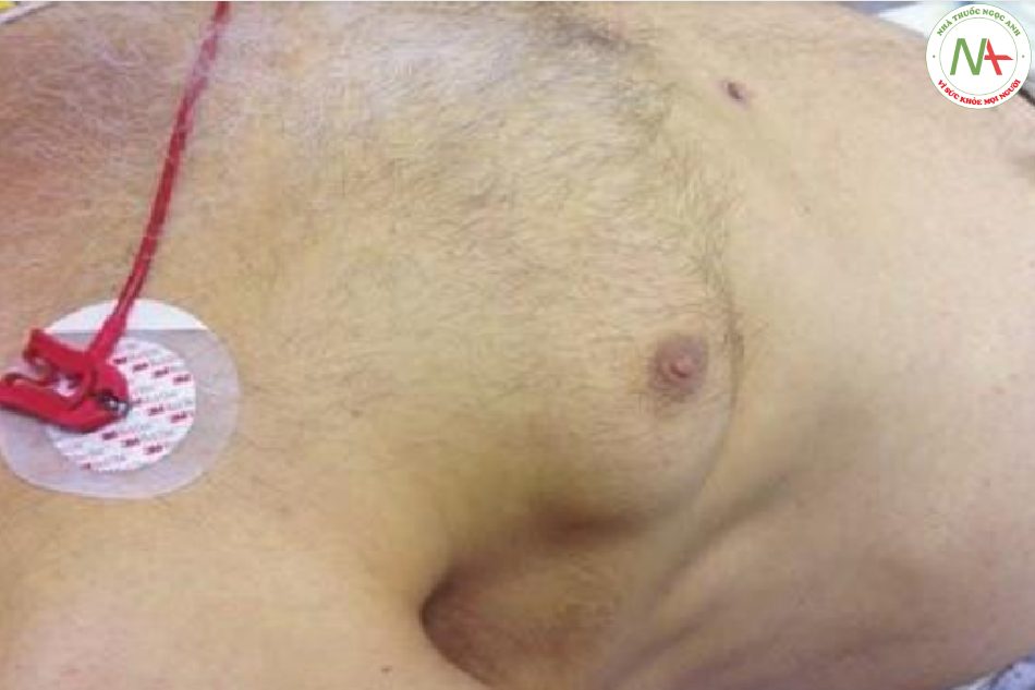 Hình 9.10 Nhủ hóa tuyến vú ở một bệnh nhân nam bị xơ gan