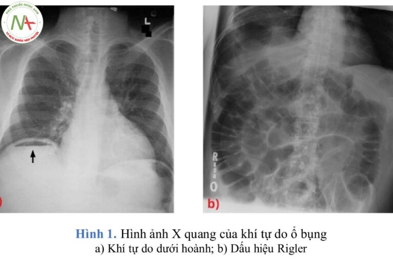 Thủng tạng rỗng là gì? Chẩn đoán và điều trị như thế nào?