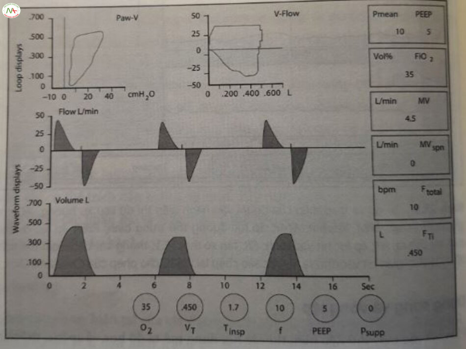 Hình 27.4 Ví dụ về man hinh may thỏ phức hợp hiển thị dữ liệu số, dạng sóng và vòng lập PEEP áp lực dương cuối thì thỏ ra. (Được sao chép lại với sự cho phép của Cleveland Clinic)