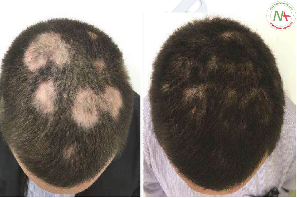Bệnh nhân bị rụng tóc từng mảng được điều trị bằng cách tiêm triamcinolone trong da (a) trước và (b) sau hai buổi điều trị với biểu hiện tóc mọc lại gần như hoàn toàn