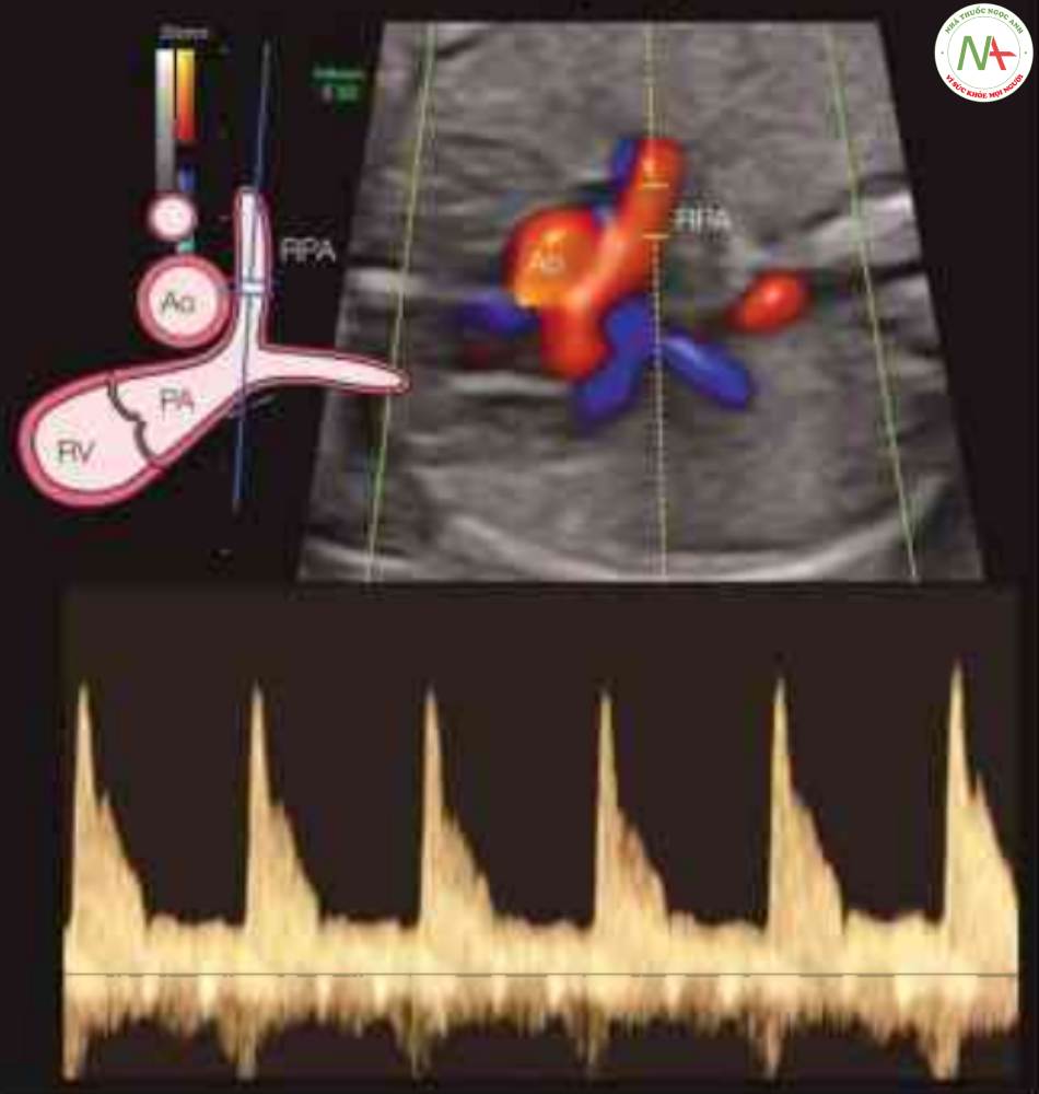 Hình 10: Các dạng sóng Doppler qua động mạch phổi phải (RPA) trong mặt cắt trục ngắn