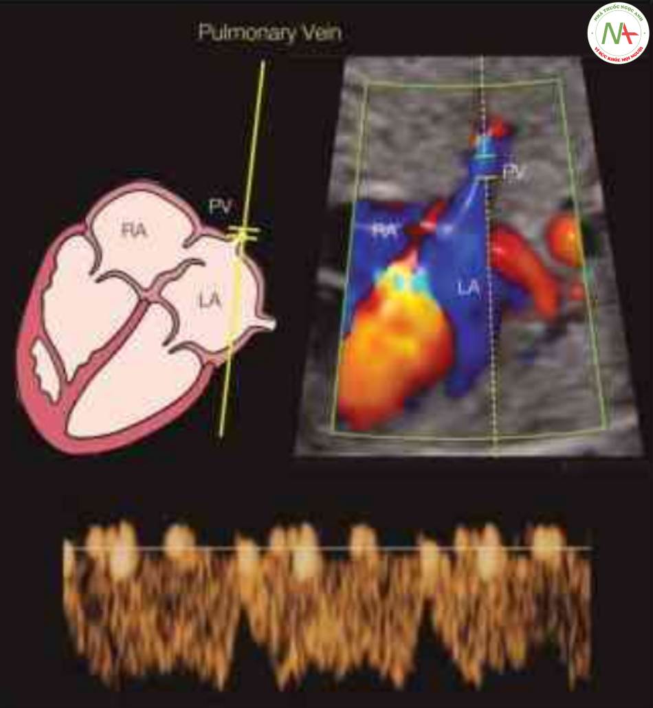 Hình 14: Các dạng sóng Doppler thu được từ tĩnh mạch phổi