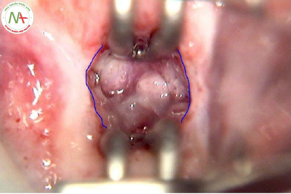 Hình 20: SCJ bên trong ống cổ tử cung (được hiển thị bằng mỏ vịt ống cổ tử cung)