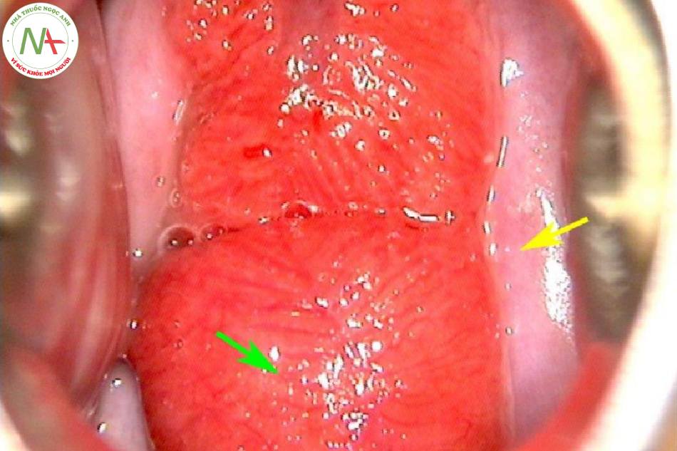 Hình 22: Lộ tuyến sau khi làm sạch cổ tử cung bằng nước muối sinh lý