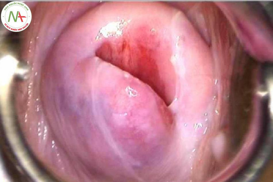 Hình 26: Mảng màu đỏ bên trong ống cổ tử cung trước khi bôi axit axetic