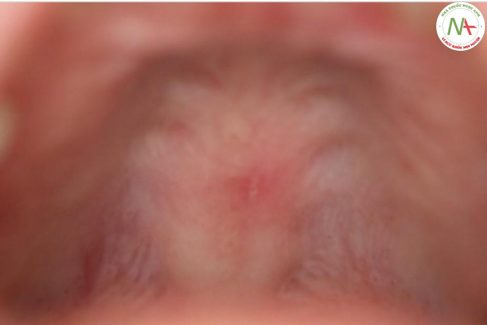 Hình 3. Vết loét gây đau có đáy trắng (2-mm đường kính) ở khẩu cái cứng của phần niêm mạc miệng