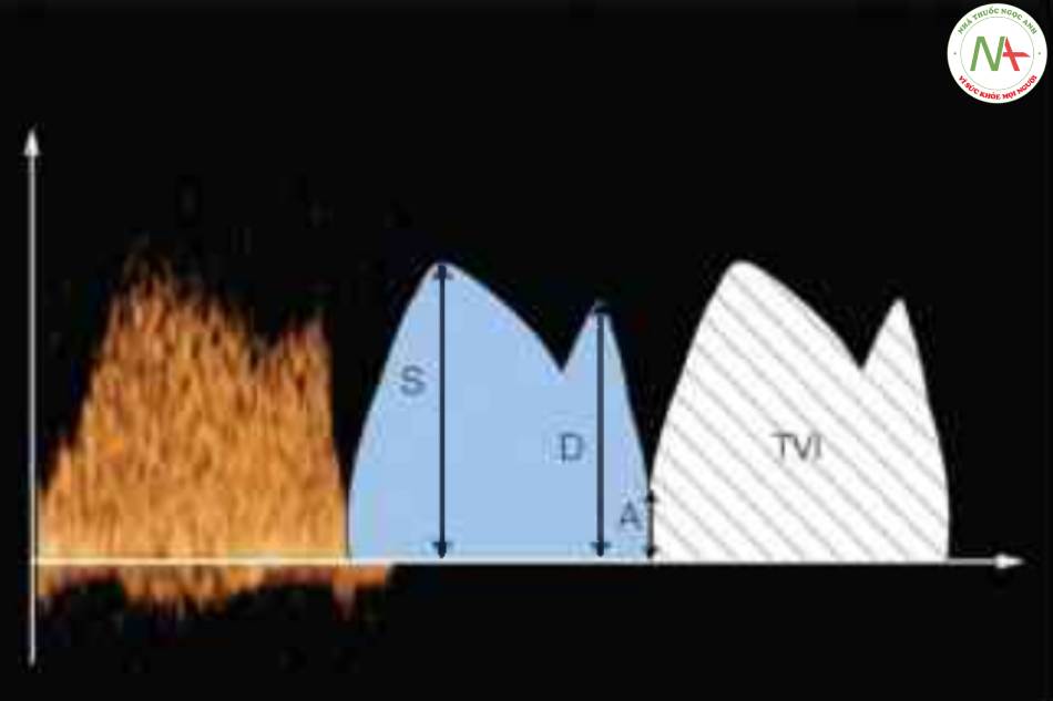 Hình 5: Định lượng dạng sóng Doppler qua ống tĩnh mạch (DV)
