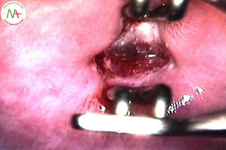 Hình 60: Vùng chuyển tiếp loại 2 (SCJ bên trong ống cổ. Lưu ý tổn thương ở môi trước, có thể nhìn thấy sau khi đặt mỏ vịt trong ống cổ)