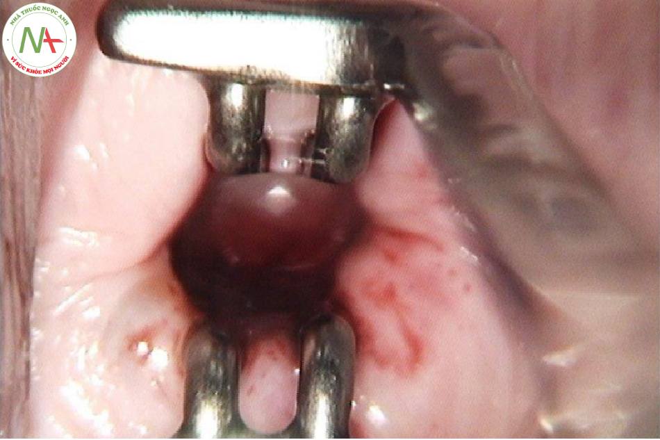Hình 62: Vùng chuyển tiếp loại 3 (mỏ vịt ống cổ tử cung được sử dụng để mở ống cổ tử cung)