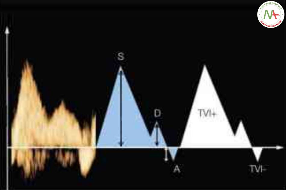 Hình 6: Định lượng dạng sóng Doppler qua tĩnh mạch chủ dưới, tĩnh mạch chủ trên hoặc tĩnh mạch gan