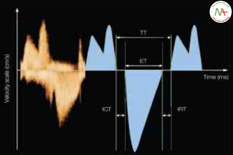 Hình 8: Các dạng sóng Doppler qua van hai lá hiển thị các khoảng thời gian trong chu chuyến tim thường được sử dụng trong đánh giá chức năng tim