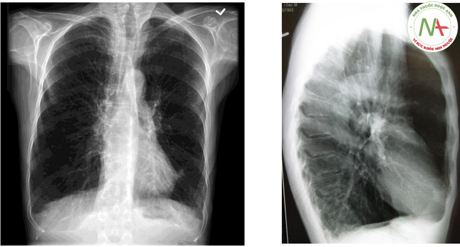 Hình ảnh khí phế thũng và biến dạng lồng ngực trên một bệnh nhân COPD