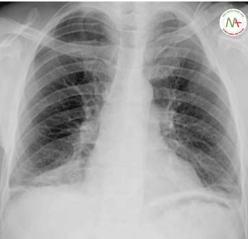 Hình ảnh xẹp phổi dạng vệt: Hình xẹp phổi dạngvệt thùy dưới phải