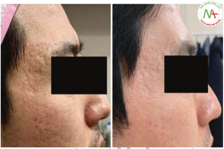 Hình chụp trước và sau điều trị sẹo mụn bằng laser CO2 phân đoạn